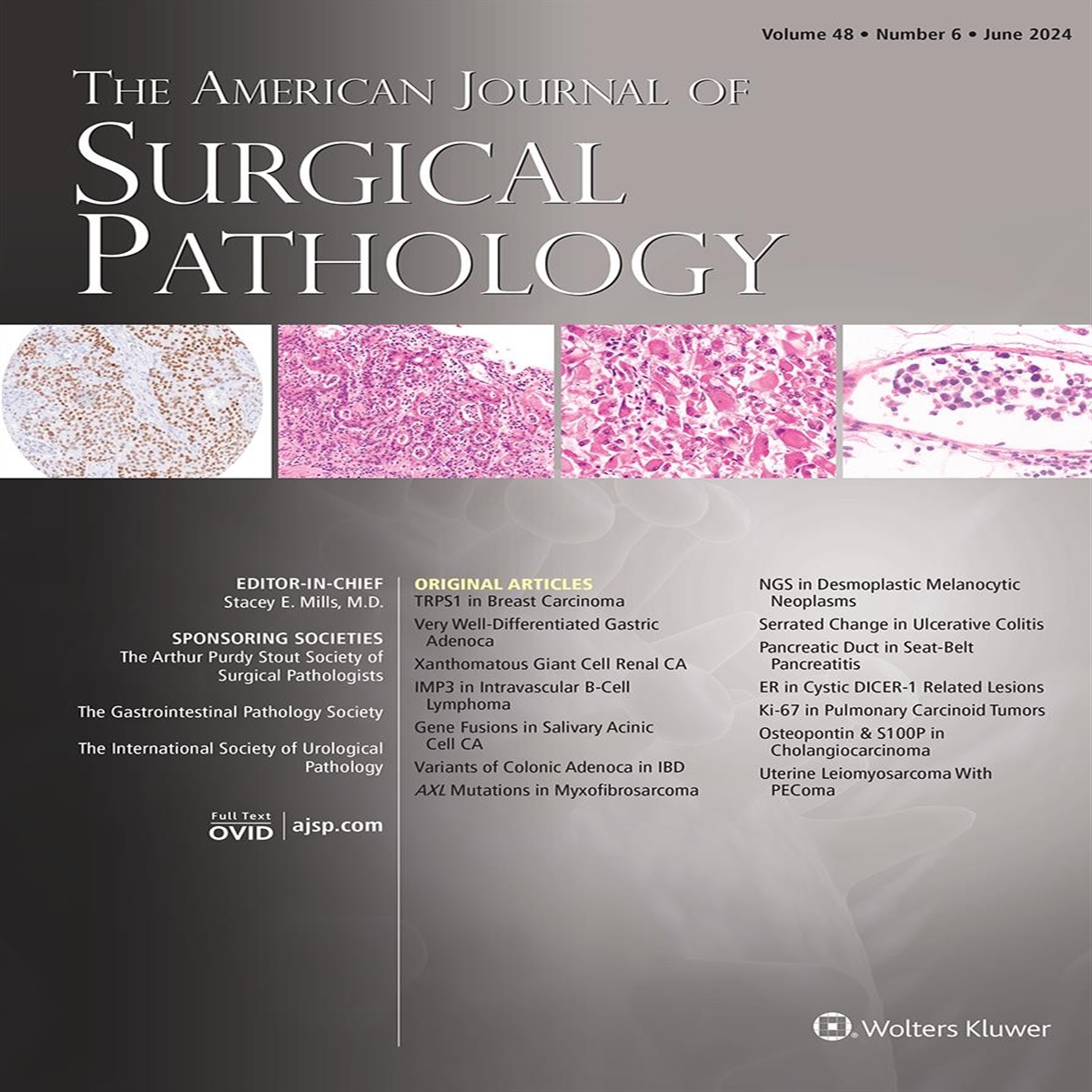 In Response to Ovarian Sex Cord Tumor Harboring FUS::CREM Fusion: An Ovarian Counterpart of Inflammatory and Nested Testicular Sex Cord Tumor
