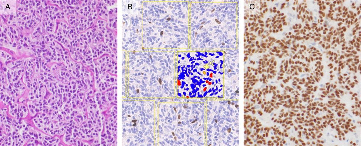 Prognostic Immunohistochemistry for Ki-67 and OTP on Small Biopsies of Pulmonary Carcinoid Tumors: Ki-67 Index Predicts Progression-free Survival and Atypical Histology