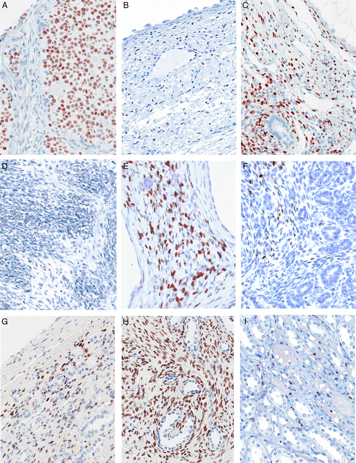 Estrogen Receptor Expression in DICER1-related Lesions is Associated With the Presence of Cystic Components