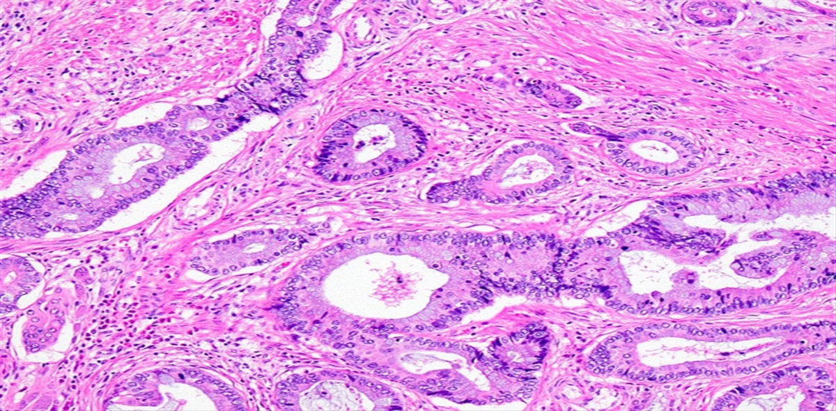 Nonconventional Dysplasia is Frequently Associated With Goblet Cell Deficient and Serrated Variants of Colonic Adenocarcinoma in Inflammatory Bowel Disease
