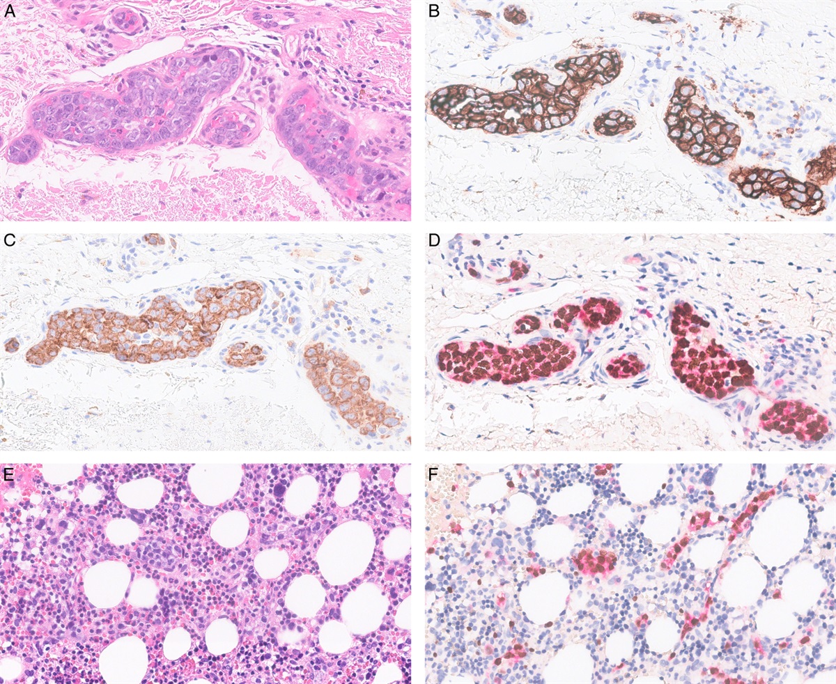 Insulin-like Growth Factor II mRNA-binding Protein 3 is a Highly Sensitive Marker for Intravascular Large B-cell Lymphoma: Immunohistochemical Analysis of 152 Pathology Specimens From 88 Patients
