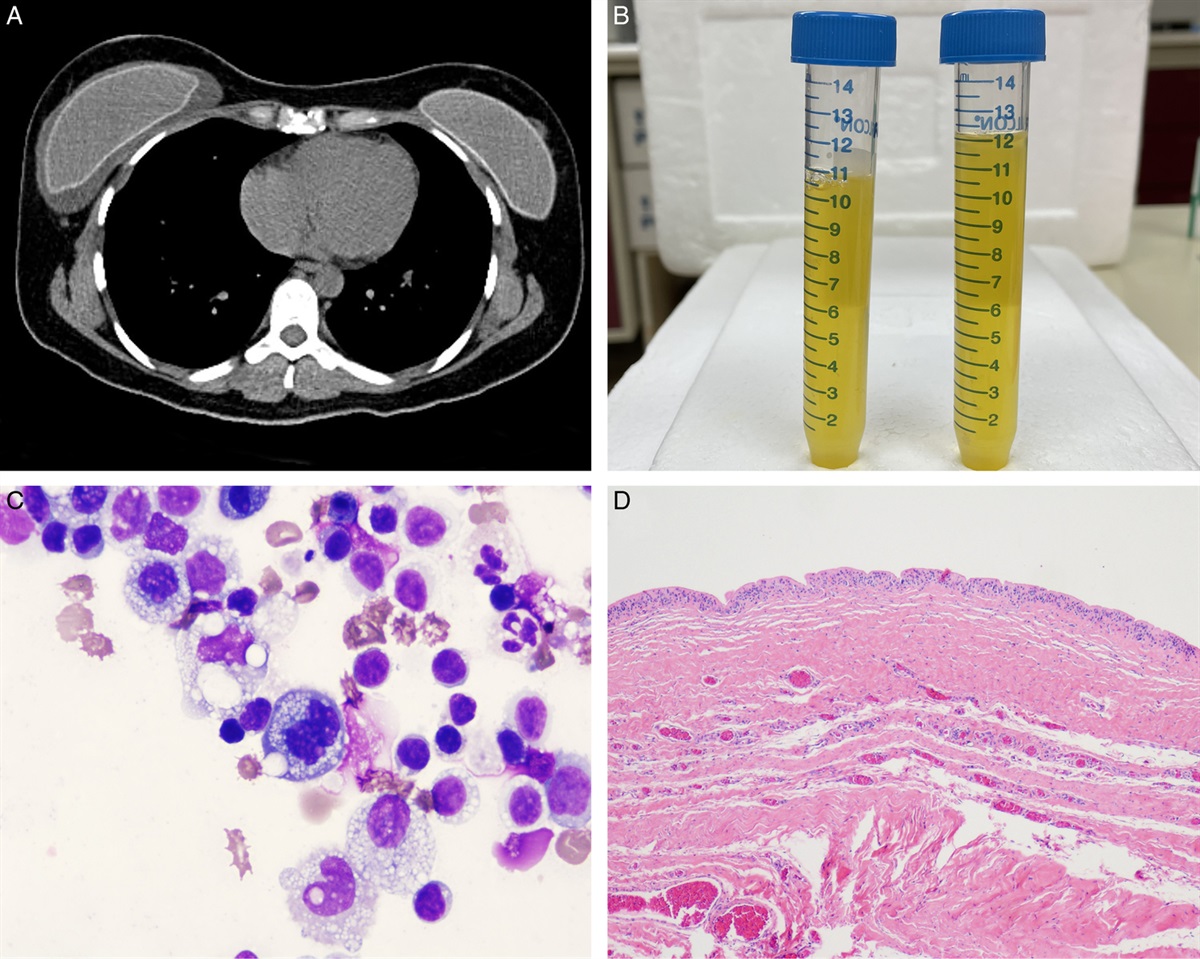 The Spectrum of Non-neoplastic Changes Associated With Breast Implants: Histopathology, Imaging, and Clinical Significance