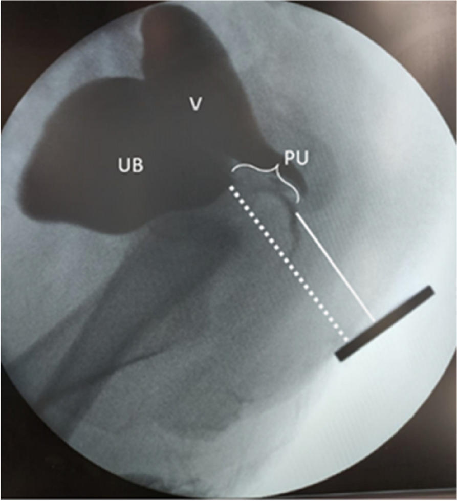 Preoperative evaluation of the persistent urogenital sinus in cases with congenital adrenal hyperplasia