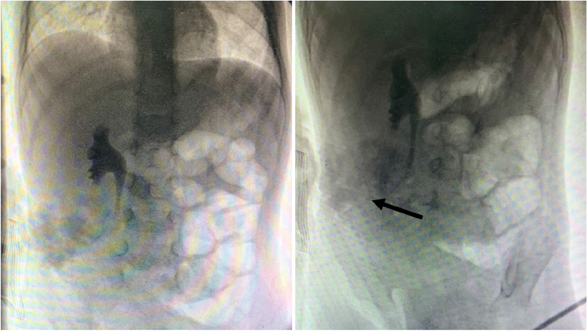Management of uretero-colonic fistulas and ureteral injuries: a comprehensive surgical and endoscopic approach