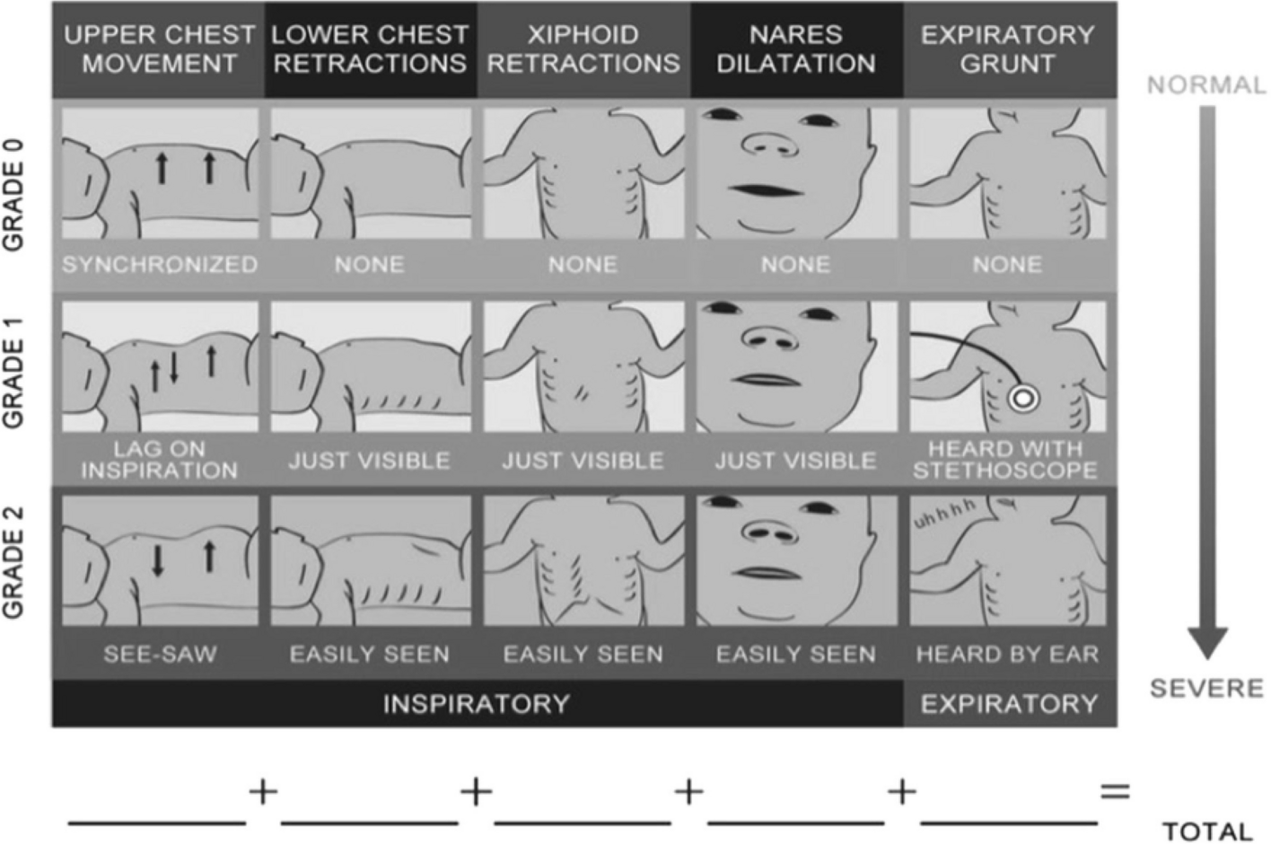 Platelet indices as a predictive marker in neonates with respiratory distress