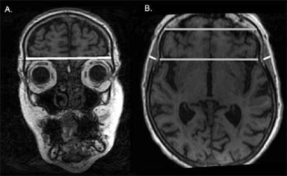 Temporal Muscle Thickness Predicts Mortality and Disability in Older Adults Diagnosed with Mild Dementia
