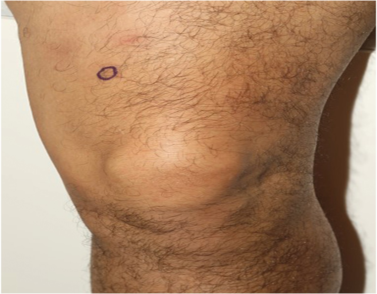 Indurated Subcutaneous Thigh Nodules: Challenge