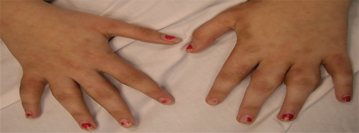 Painless Symmetric Thickening of Proximal Interphalangeal Joints in an Adolescent Girl: Challenge