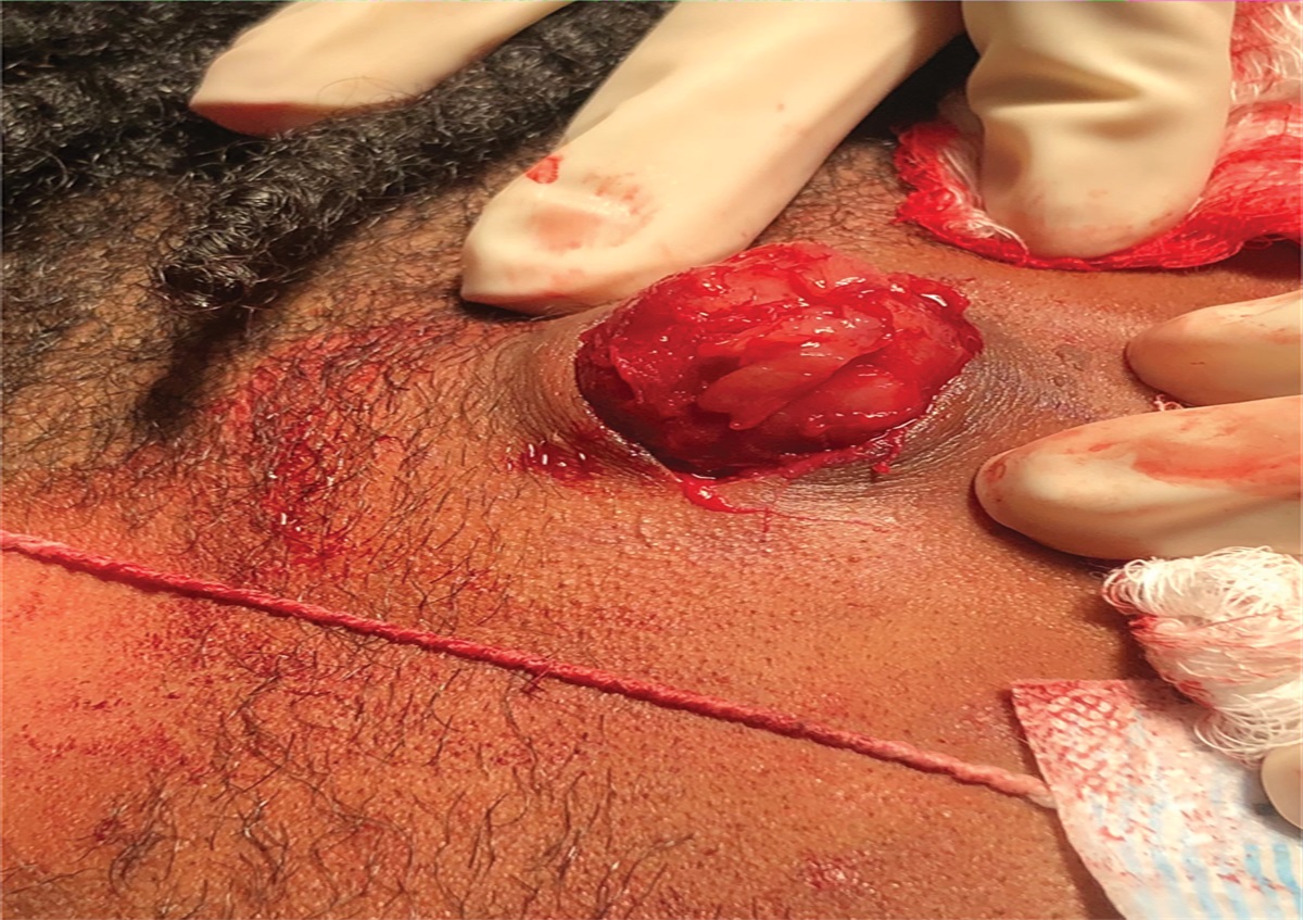 A Firm, Subcutaneous Nodule on the Temple of an African American Adolescent Boy: Challenge