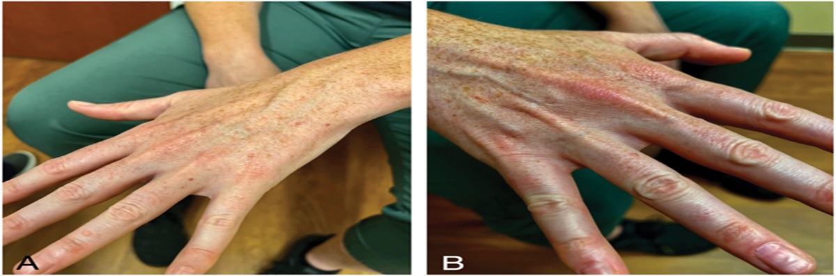 An Isolated Presentation of Multiple Flesh-Colored Papules on the Dorsal Hands and Forearms: A Diagnostic Challenge