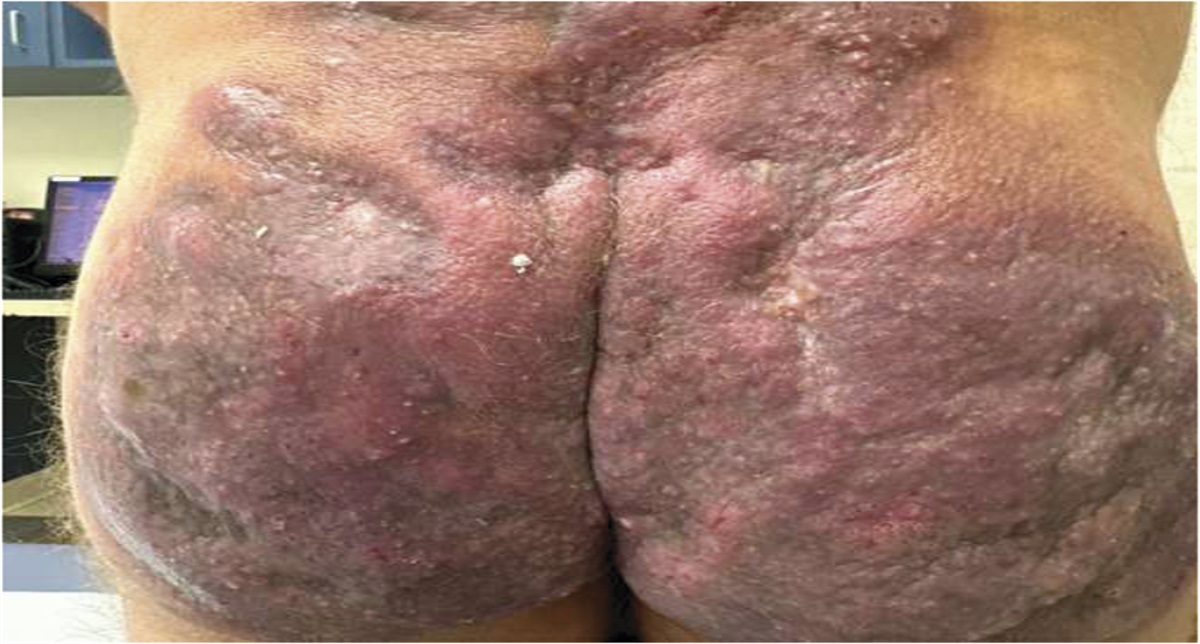 Chronic Painful Vegetative Plaques on the Buttocks: Challenge