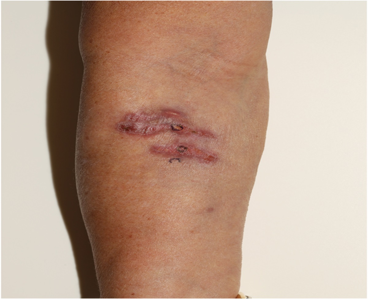 Soft Pink Plaques at Site of Breast Cancer Vaccination: Challenge