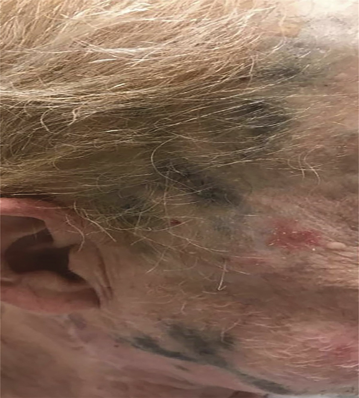 Lymphangitic Melanomatosis: Case Report of Intralymphatic Spread of Melanoma in a 66-year-old Man