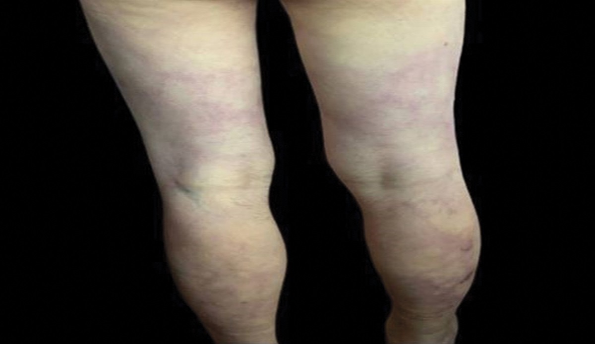 An Unusual Rash in a Recent Liver Transplant Recipient: Challenge