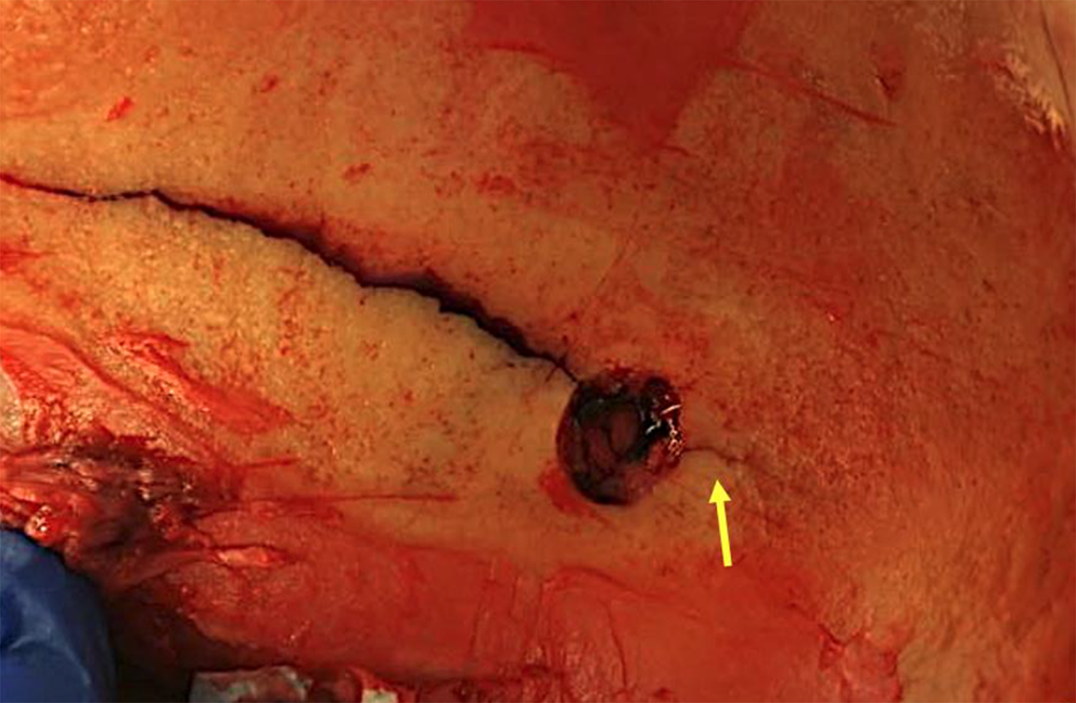 Exception to the Puppe’s rule reloaded and a warning in the interpretation of skull fractures: they run even through recent craniotomy burr holes