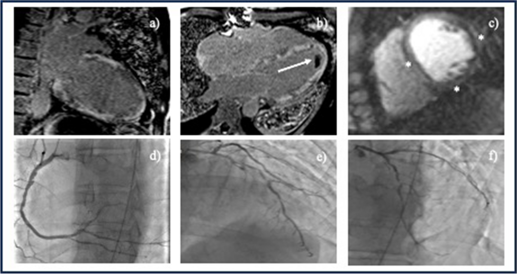 Insights of Inflammatory Heart Involvement in Cardiac Sarcoidosis – A Systemic Review