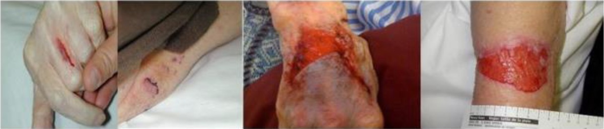 Skin Tears Preventable With a Gentle Approach: A Case Series