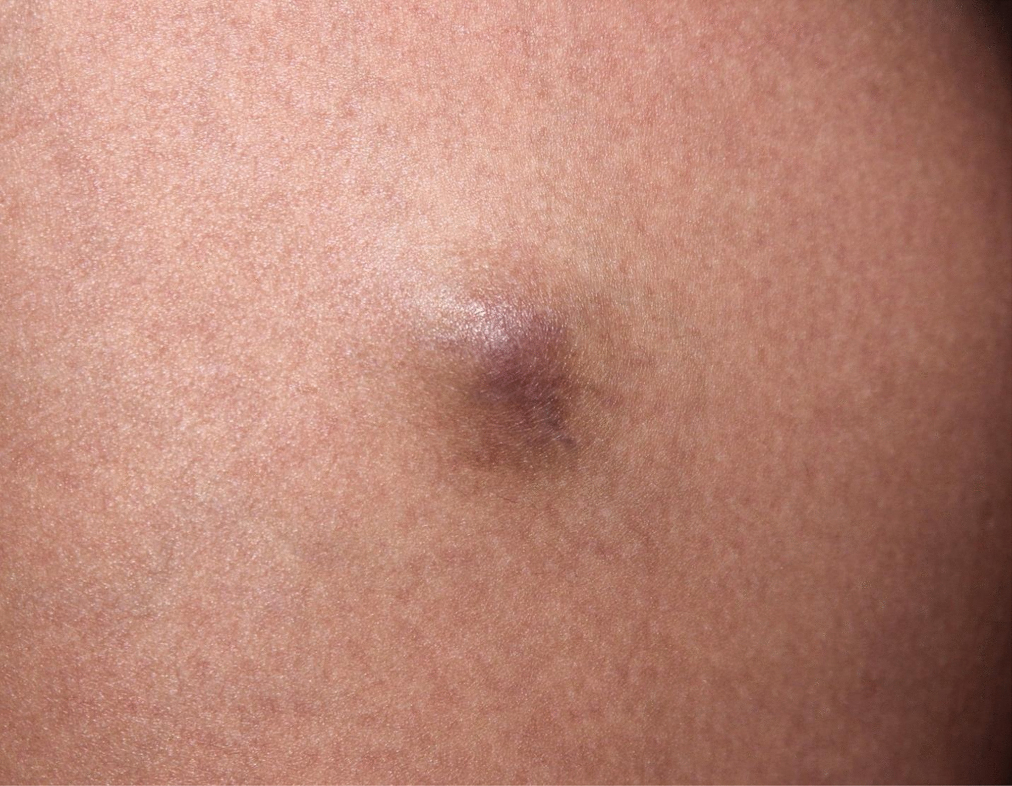Cutaneous Schwannomas: Clinical Manifestations, Diagnosis and Management: A Review