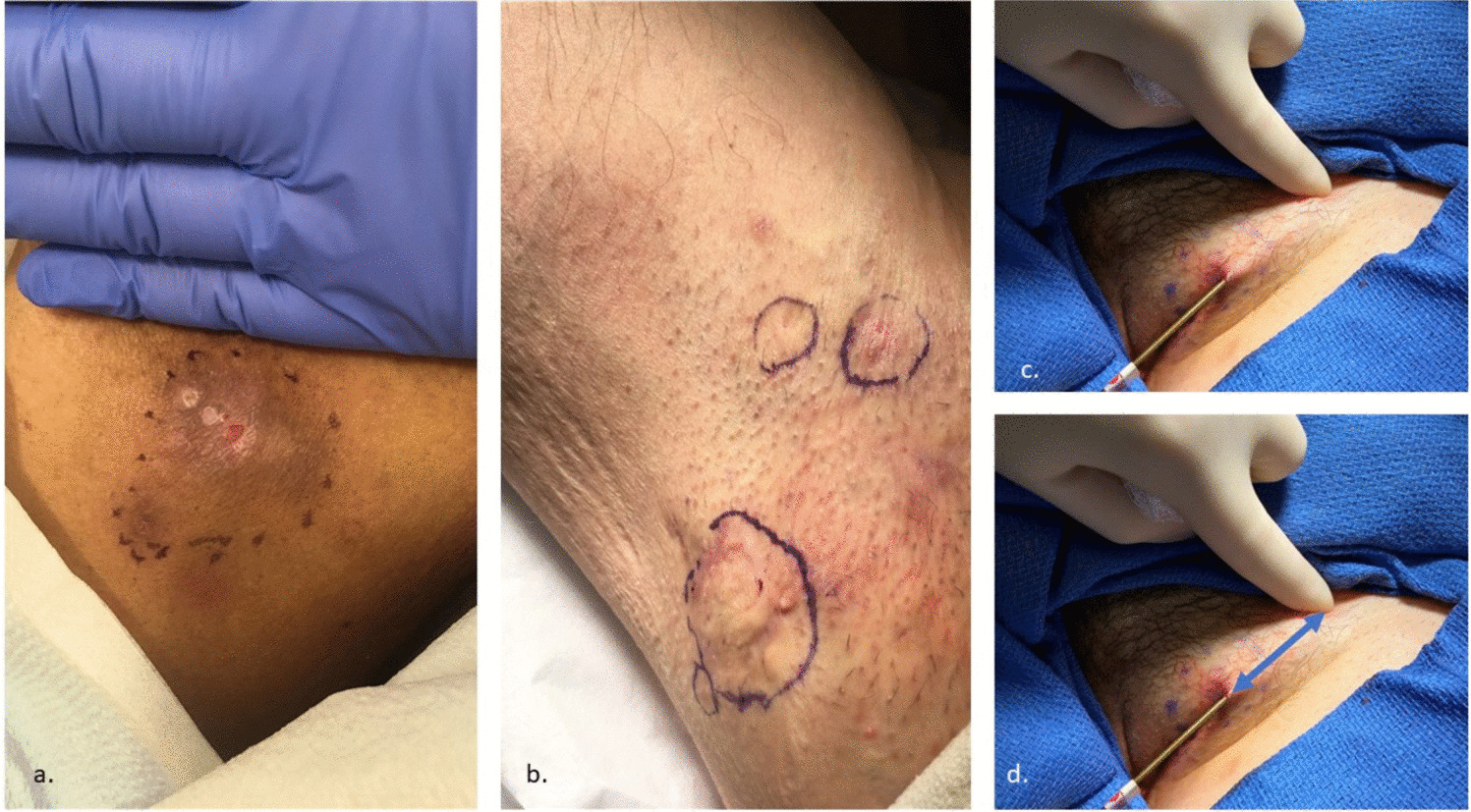 Deroofing: A Practical Guide for the Dermatologist