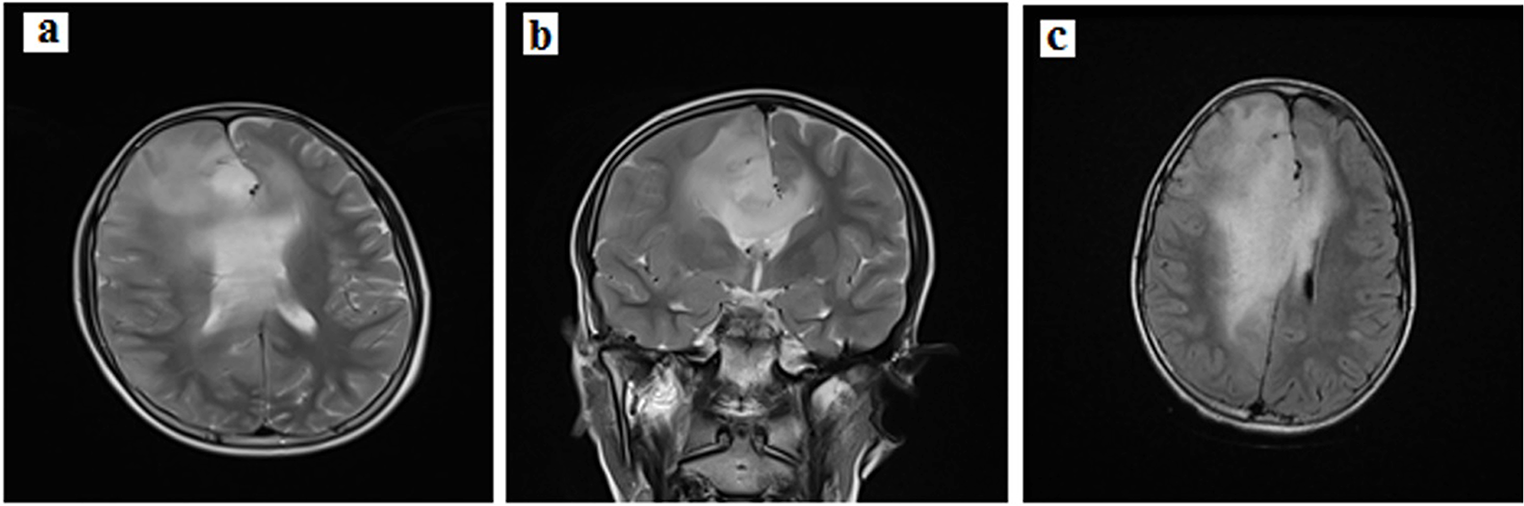 Strategies for diagnosis and management of CMMRD in low-resource countries: report of a Tunisian family