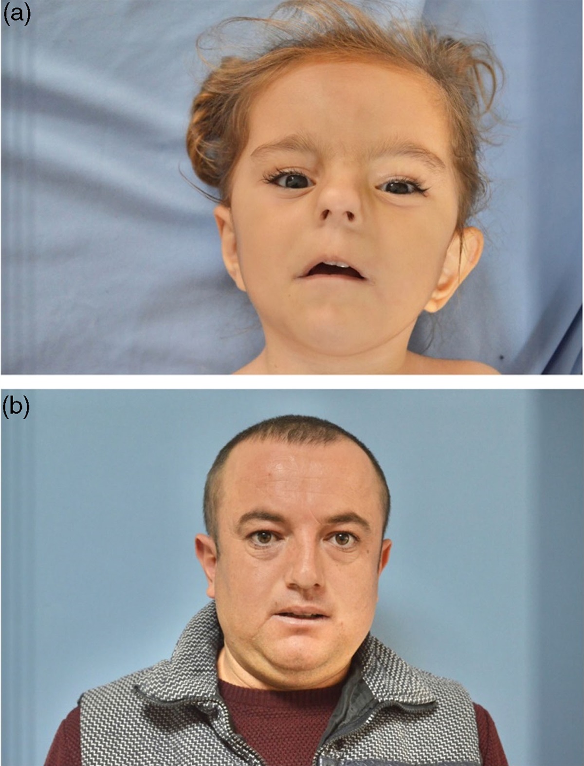 Could the 14q23.2 microdeletion or AKAP5 haploinsufficiency be a potential cause of intellectual disability?