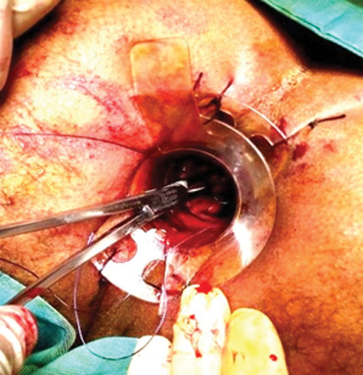 Randomized Controlled Trial to Compare Stapled Hemorrhoidopexy Plus Ligation Anopexy With Stapled Hemorrhoidopexy for Managing Grade III and IV Hemorrhoidal Disease