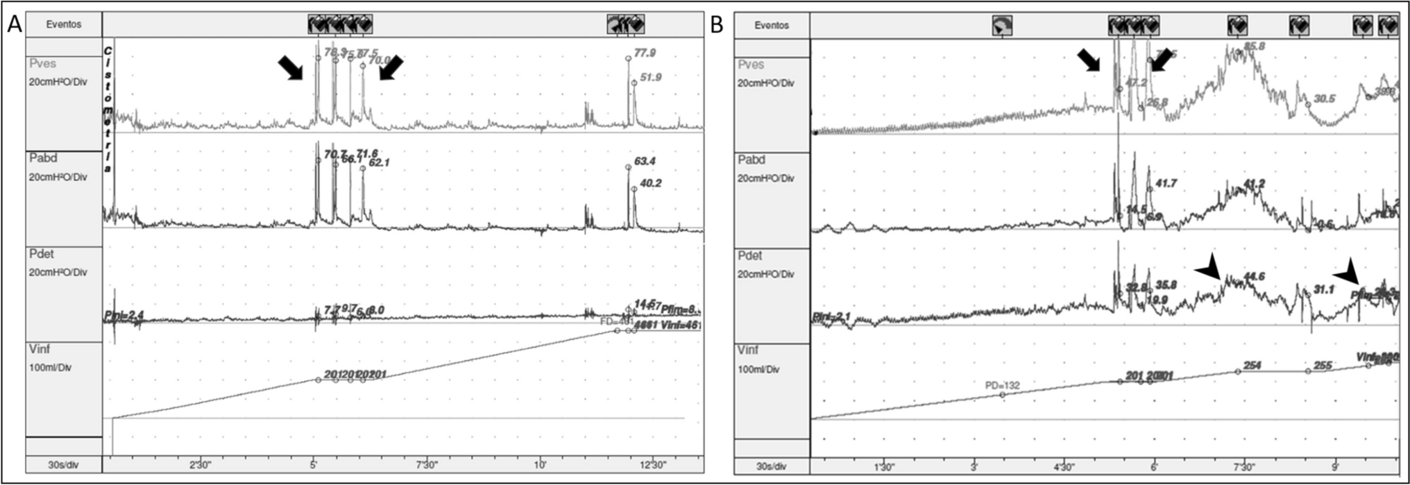 Management of Neurogenic Stress Urinary Incontinence: An Updated Review