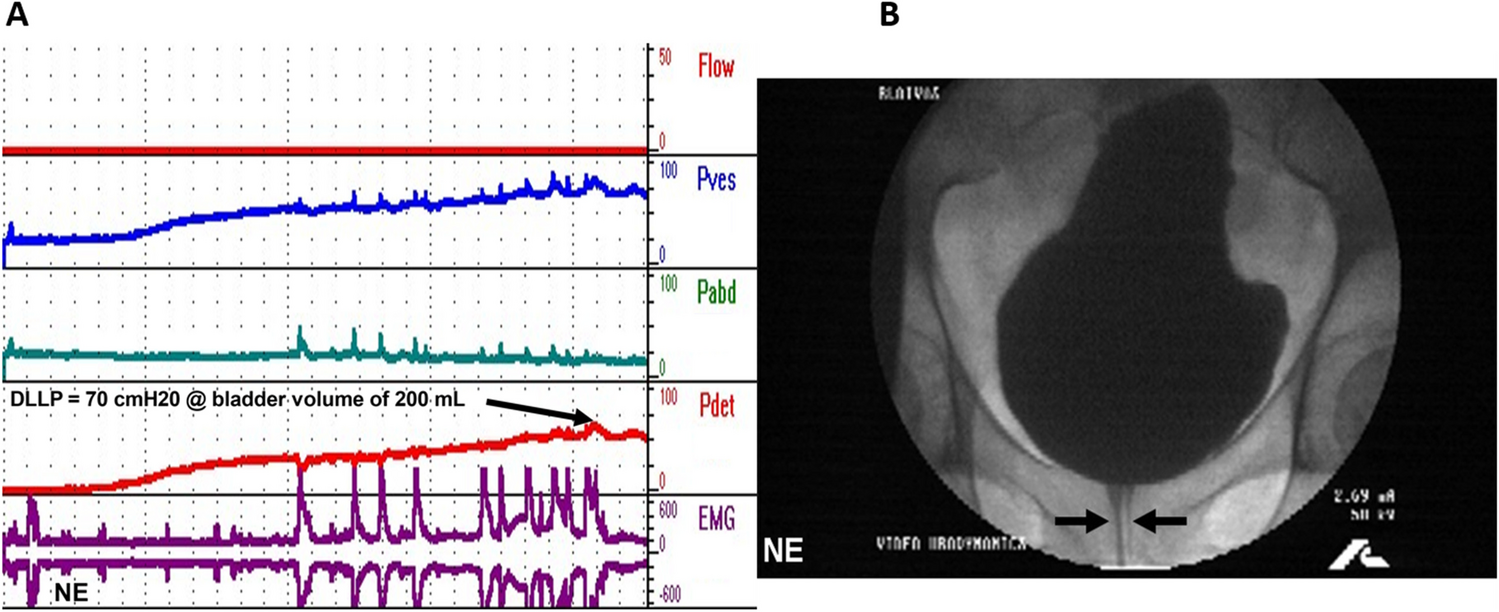 Urodynamic Findings that Are Most Impactful for Patients with Neurogenic Bladder and the Literature that Supports This