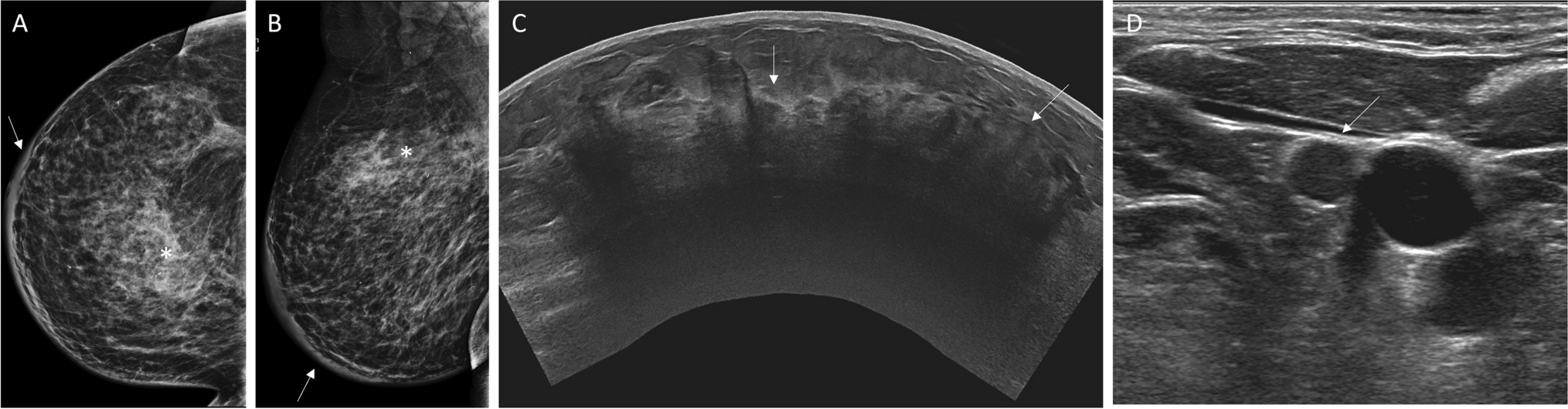 Current Imaging Approaches in Inflammatory Breast Cancer