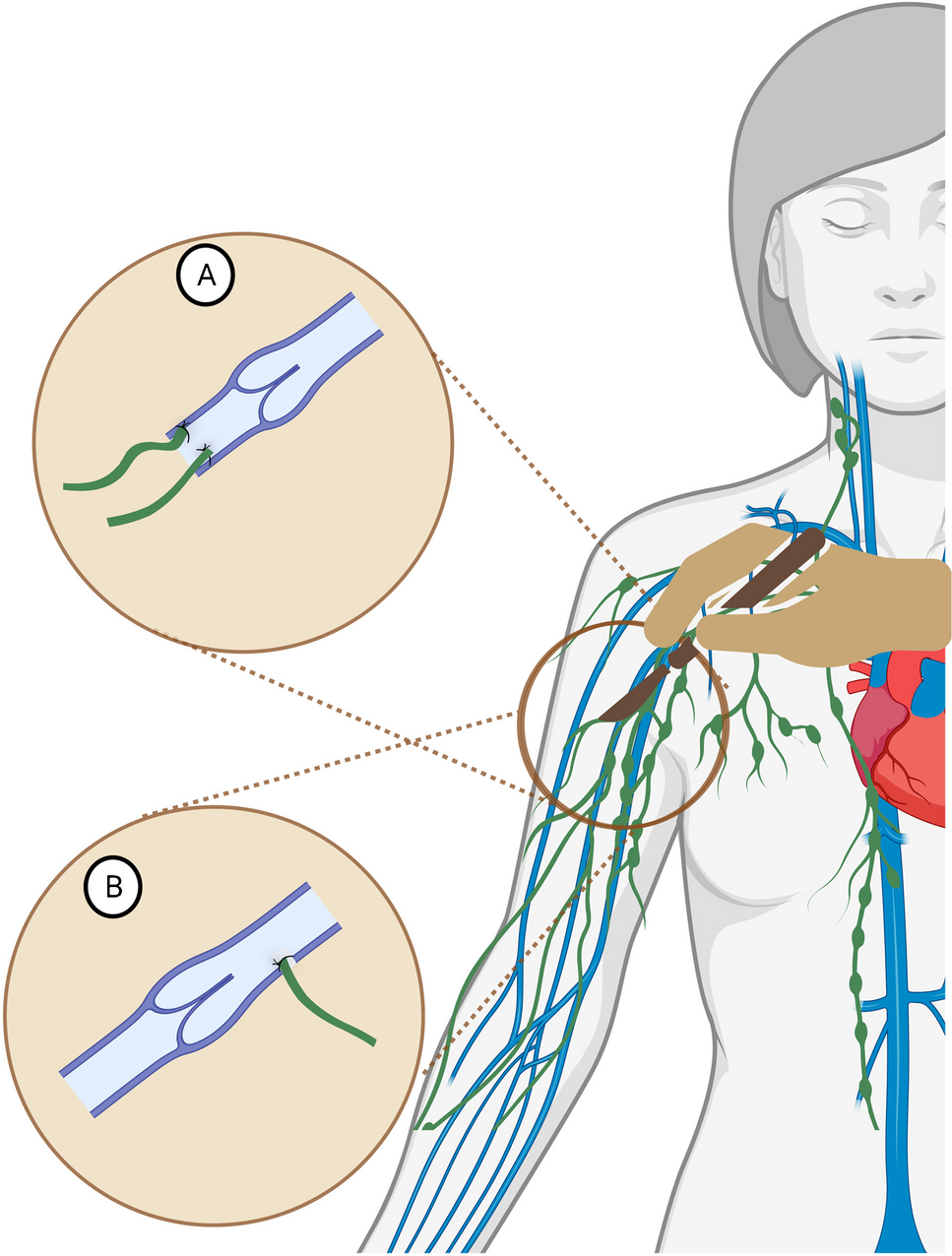 Surgery for Lymphedema Prevention and Treatment