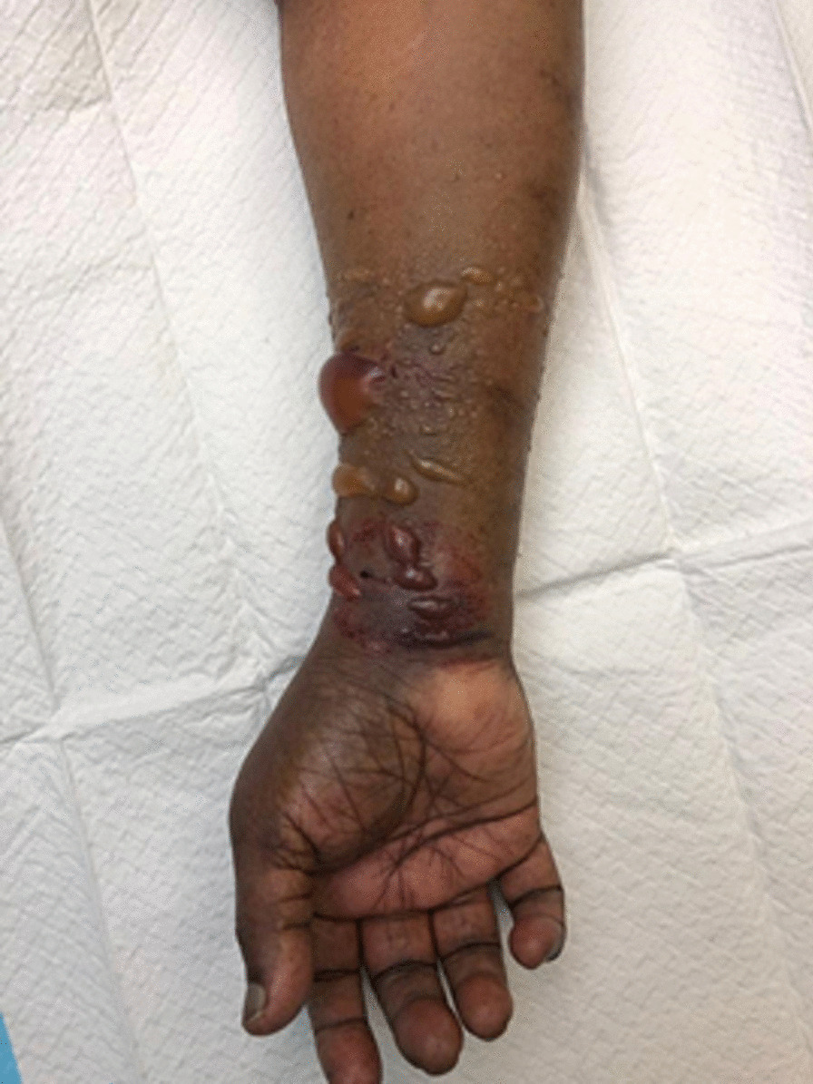 A case series of forearm compartment syndrome complicating transradial cardiac catheterization
