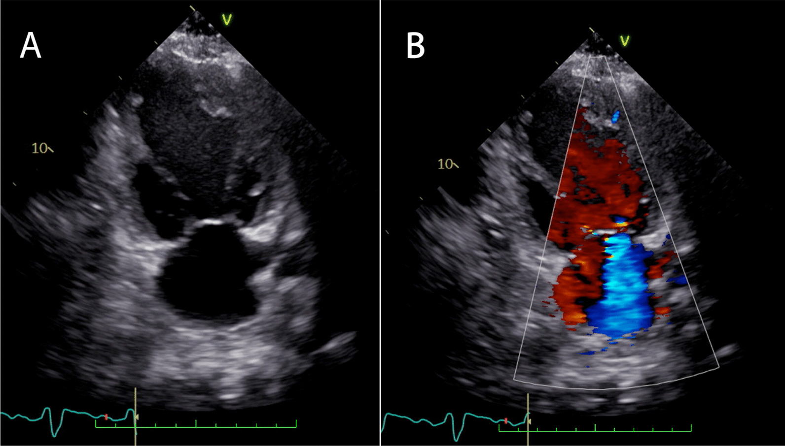 A screw-type pacemaker lead implanted in the right atrium perforated the ascending aorta