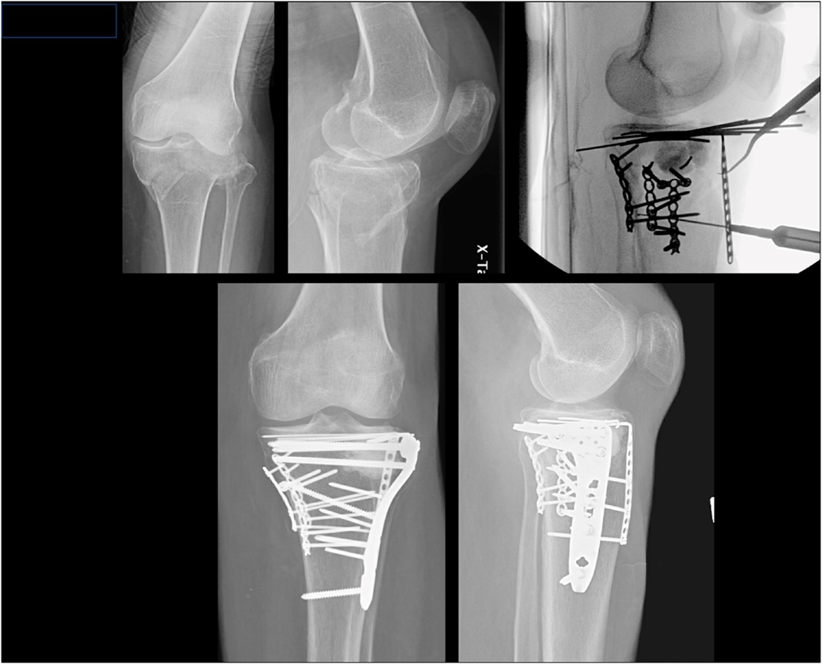 Intraosseous Shelf Plate Fixation for Depressed Articular Fragments in Tibial Plateau Fractures: A Technical Trick and Case Series