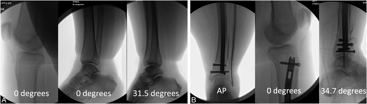 The Intermalleolar Method for Intraoperative Rotational Assessment of the Tibia—A Prospective Clinical Validation Study
