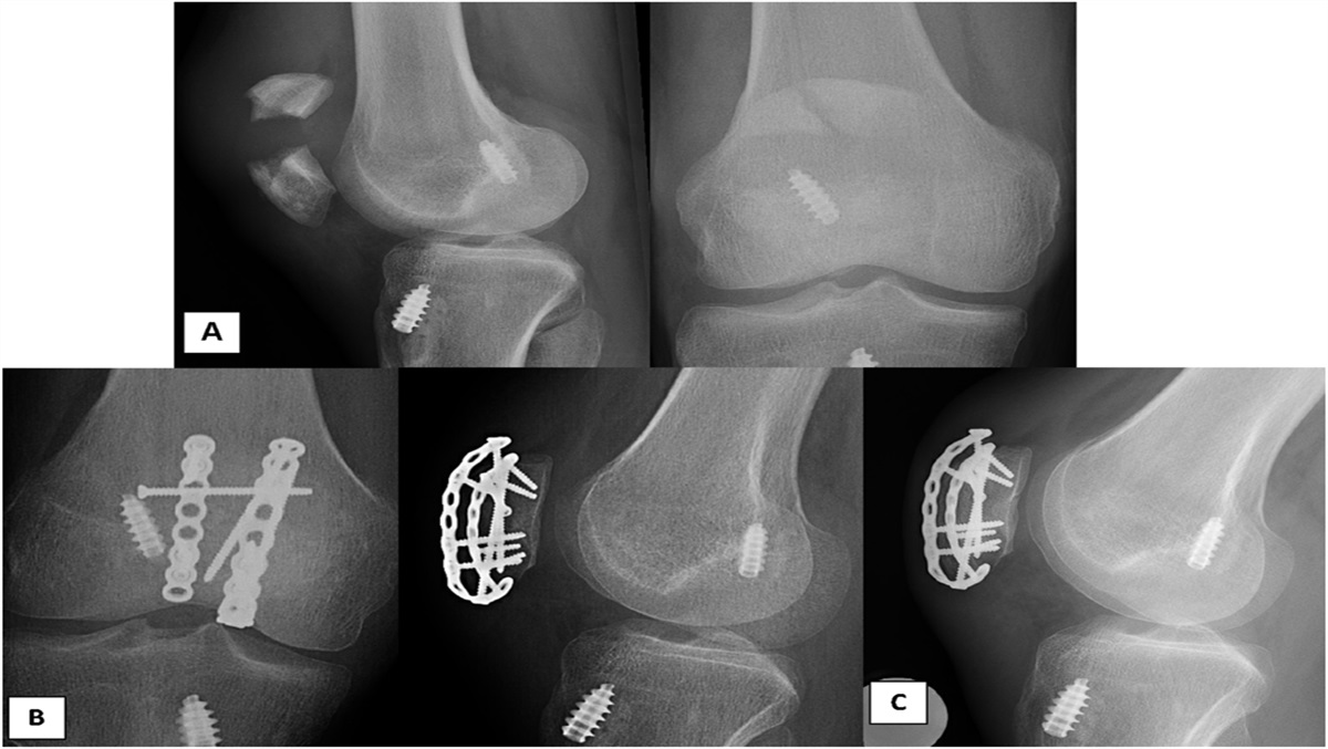 Dorsal Hook Plating of Patella Fractures With Immediate Range of Motion Results in Reliable Fixation, Low Implant Removal Rates, and Satisfactory Clinical Outcomes
