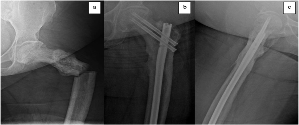 Subtrochanteric Femur Fractures: The Association Between Obesity and Perioperative, Clinical, and Radiographic Outcomes