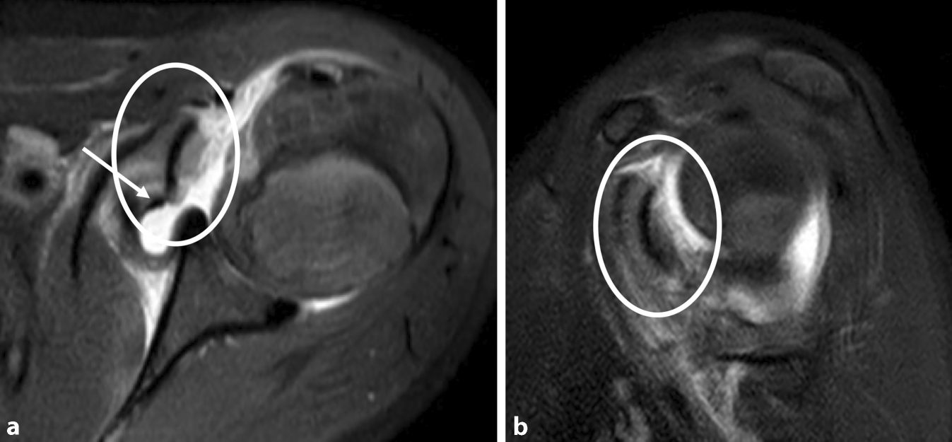 Arthroskopische Refixation einer adoleszenten periostalen Avulsion der Subscapularissehne