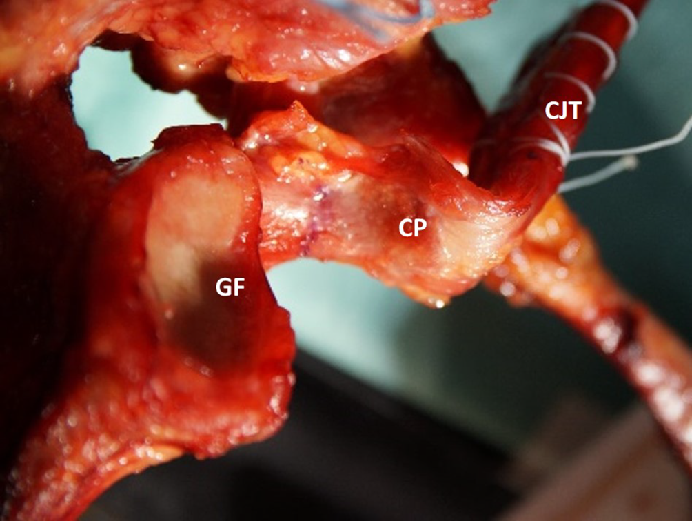 Konservative und operative Therapiemöglichkeiten bei Frakturen des Processus coracoideus scapulae – Fallserie