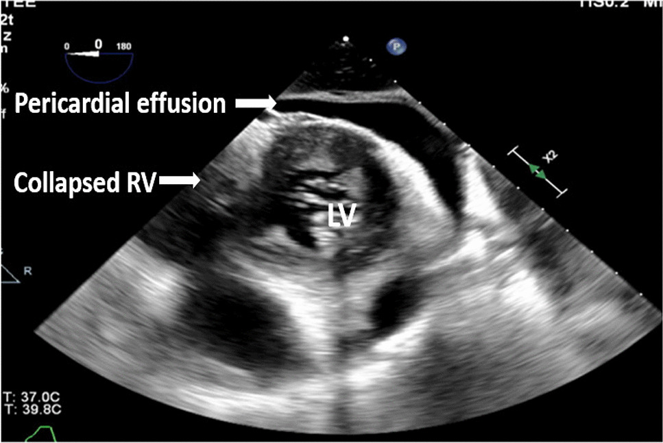 Transesophageal Echocardiography in Critical Care