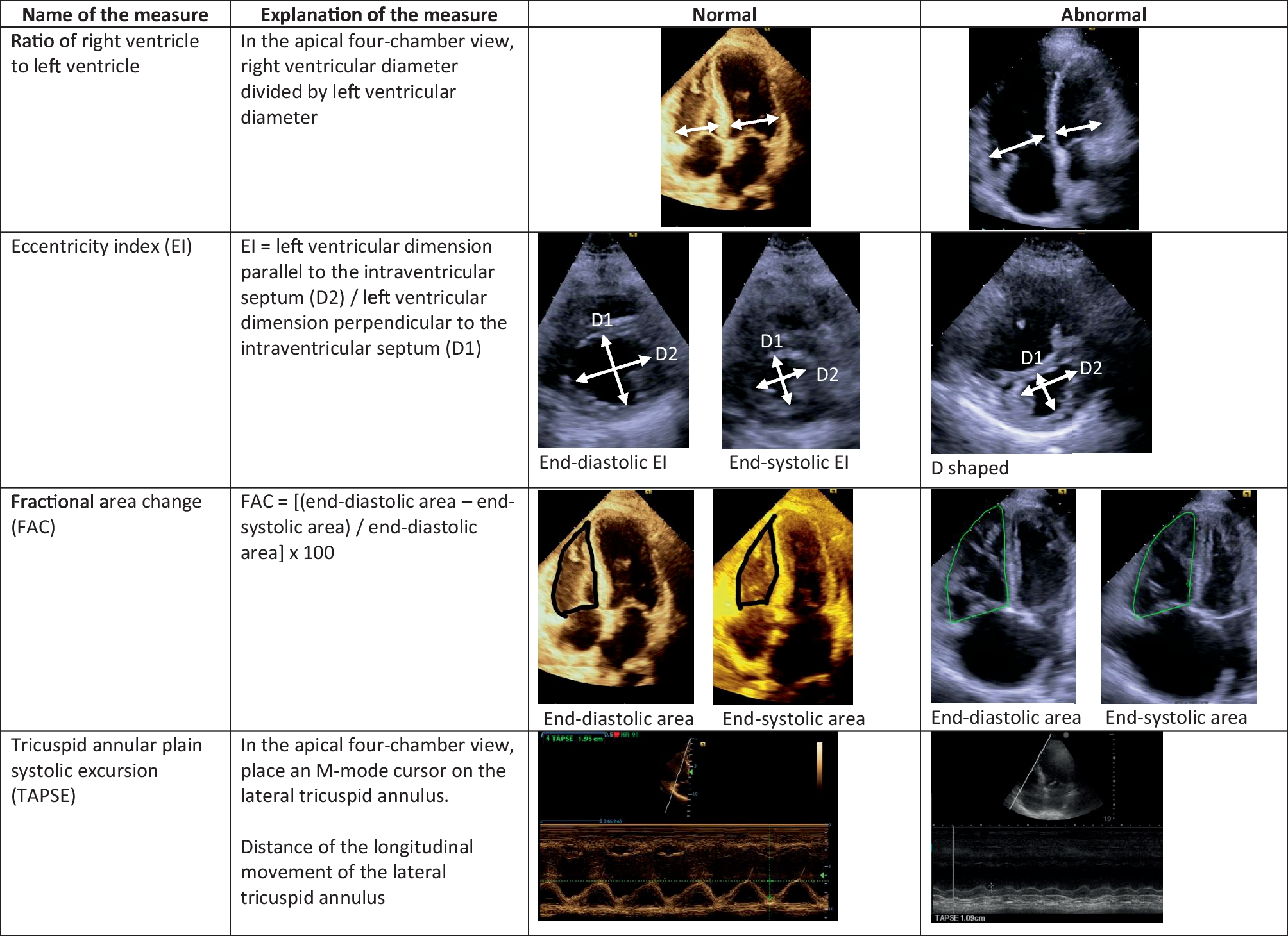 Challenges in Grading the Severity of Right Ventricular Dysfunction via Point-of-Care Echocardiography