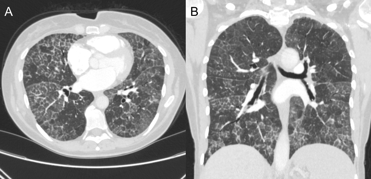 Autoimmune Pulmonary Alveolar Proteinosis: A Review of Pathogenesis and Emerging Therapies