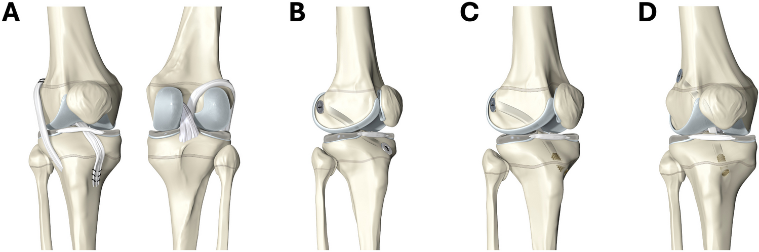 Management of Anterior Cruciate Ligament Tears in Skeletally Immature Patients