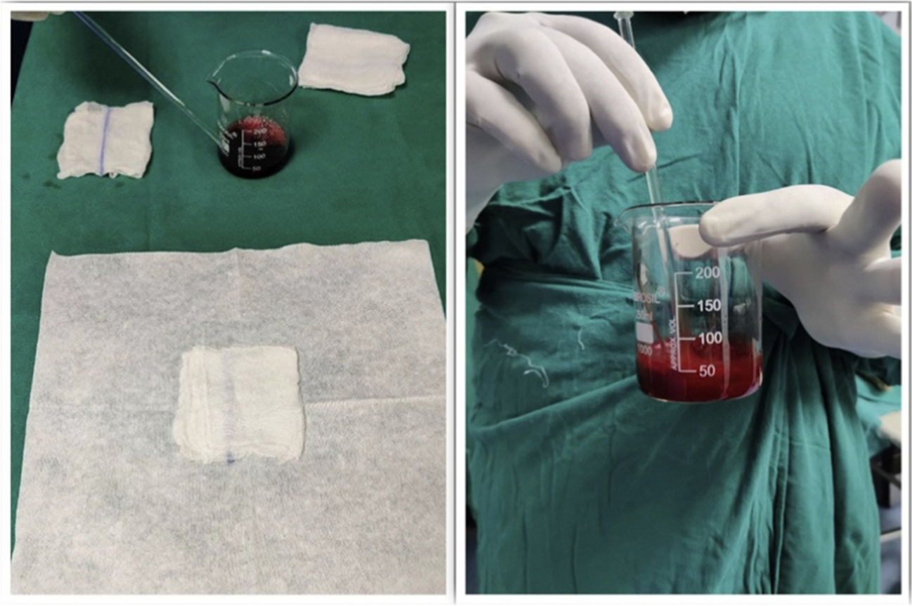 Biologic Augmentation of Isolated Meniscal Repair