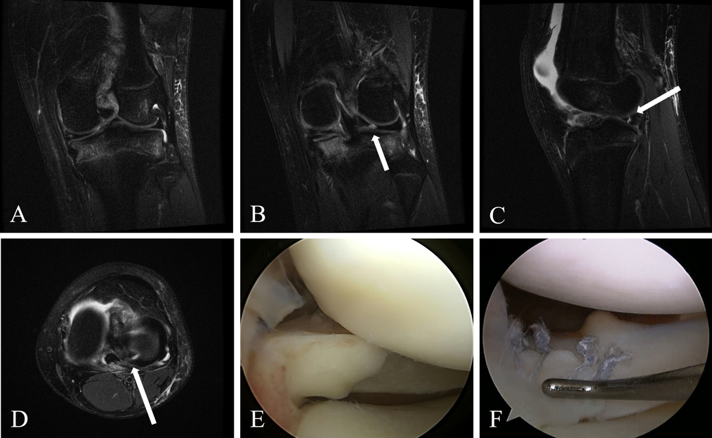 Management of Meniscus Pathology with Concomitant Anterior Cruciate Ligament Injury