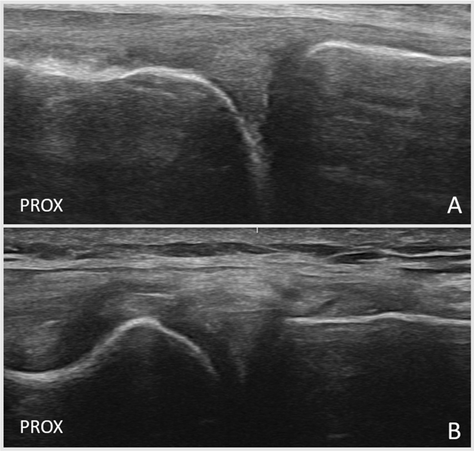 The Role of Ultrasound in the Diagnosis and Treatment of Meniscal Injuries