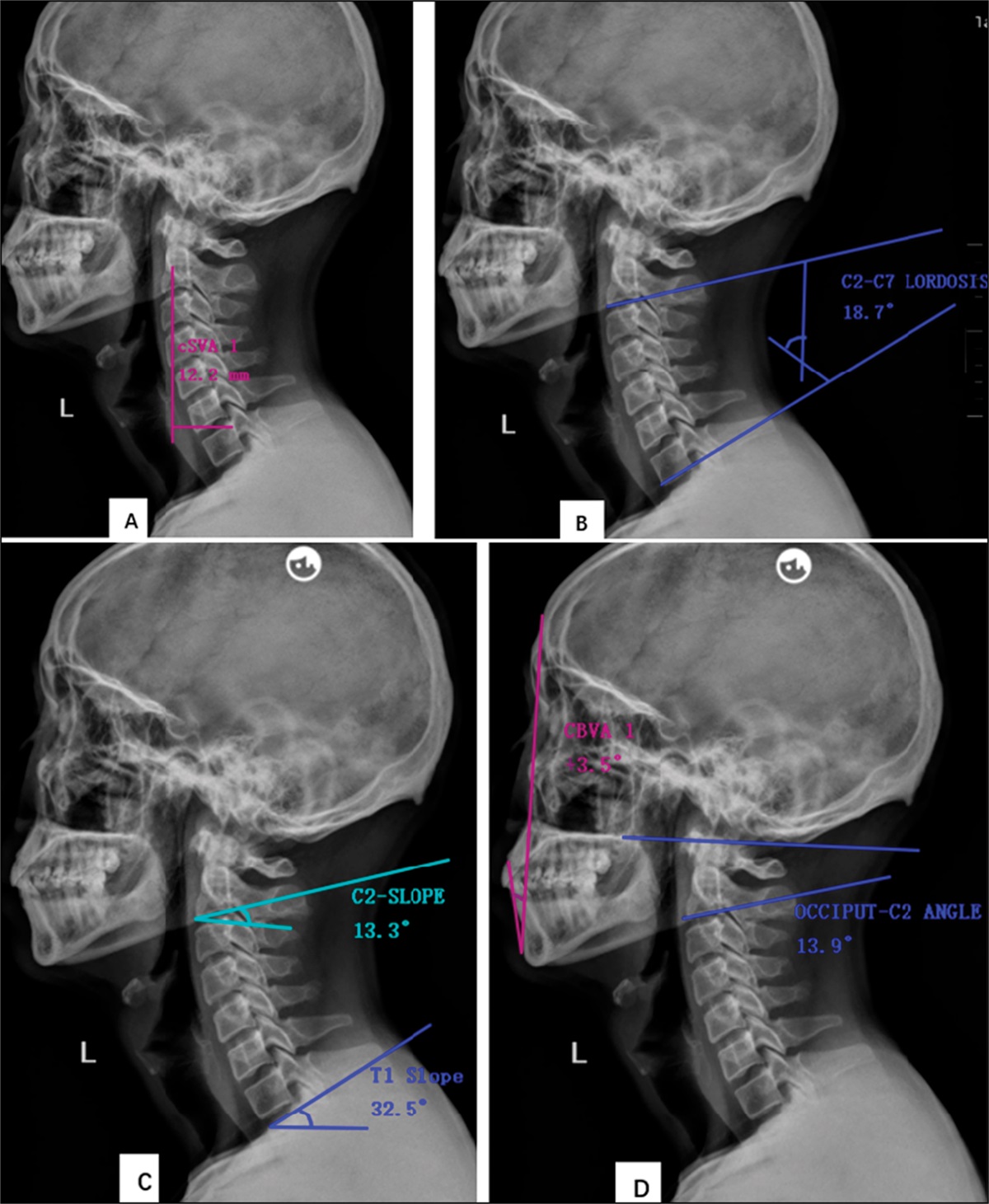 Cervical Sagittal Alignment and Related Factor Analysis and Prediction Model in Patients Undergoing Revision Surgery After Anterior Cervical Fusion