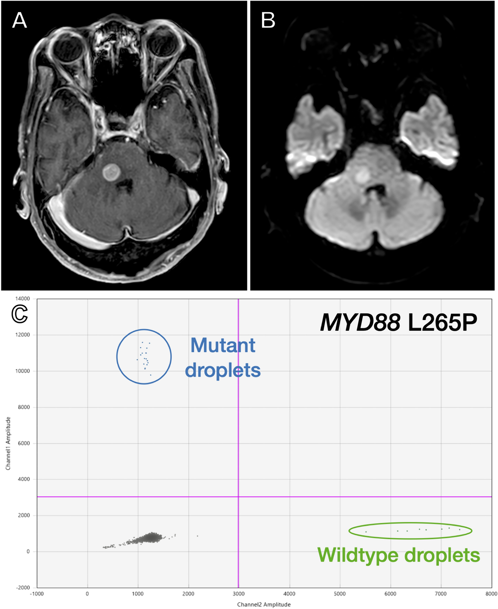 Recent advances in liquid biopsy of central nervous system lymphomas: case presentations and review of the literature