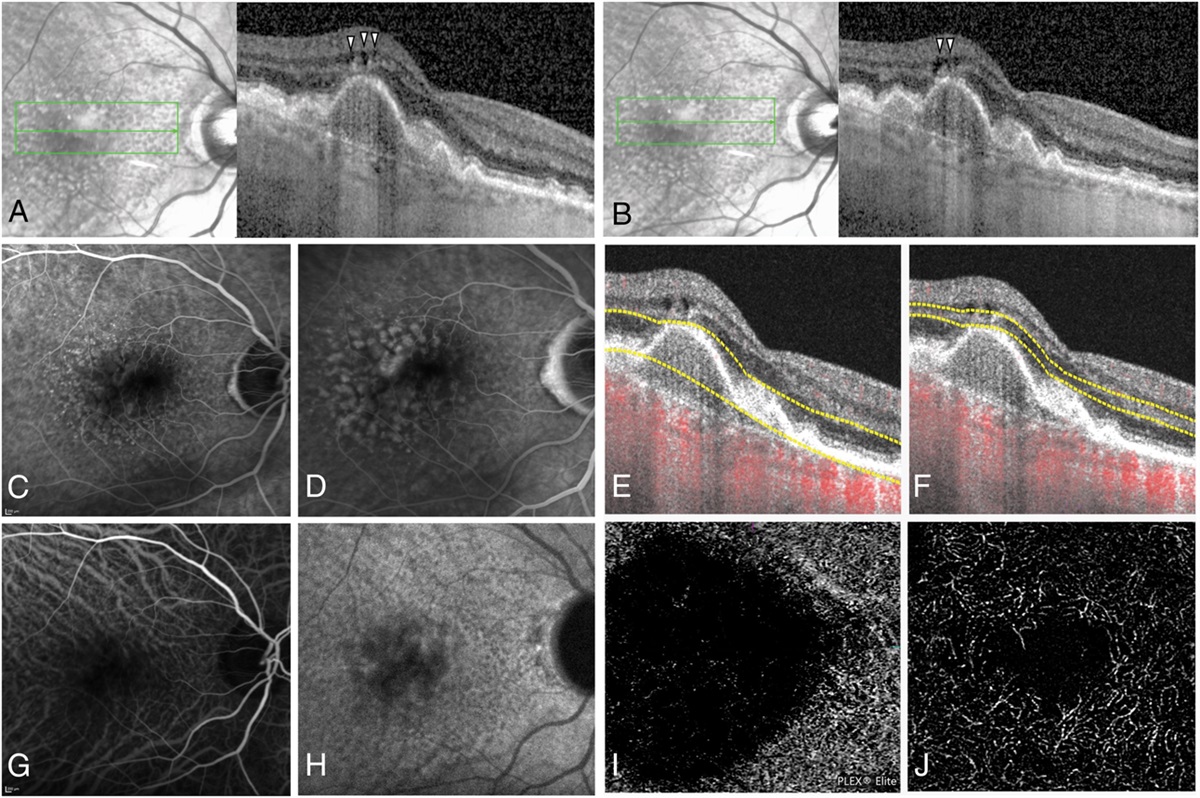 NONEXUDATIVE INTRARETINAL FLUID IN INTERMEDIATE AGE-RELATED MACULAR DEGENERATION