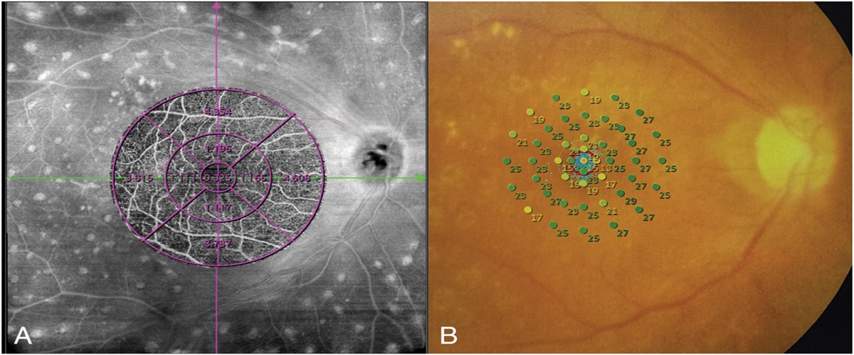 ASSOCIATION OF MACULAR STRUCTURE WITH MICROPERIMETRY SENSITIVITY FOLLOWING VITRECTOMY FOR PROLIFERATE DIABETIC RETINOPATHY