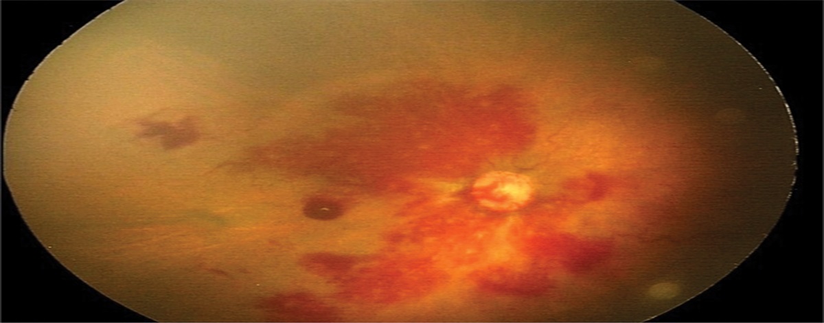 OUTCOME OF EYES TREATED FOR RETINOPATHY OF PREMATURITY IN POSTERIOR ZONE I: An Eastern India Study
